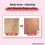 TIAM - Anti Blemish Body Lotion Back & Chest 200 ml