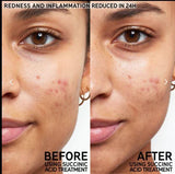 THE INKEY LIST Succinic Acid Blemish Treatment( 15ml )