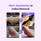 baren Foot Callus Remover Kit